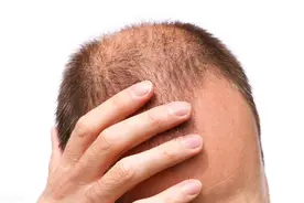 传言秃顶的男人更聪明，而且更能干，原来竟然真的有人做过研究图片