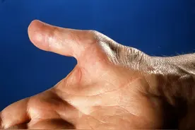 右手麻木的病因复杂多样，你知道几种？图片