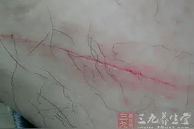 男人被这物刺伤后未处理险截肢图片