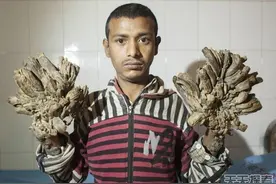 男子患怪病手脚增生似树人图片