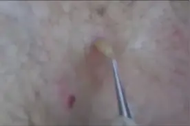实拍摘除男子后背上的寄生虫 太恐怖了！视频封面