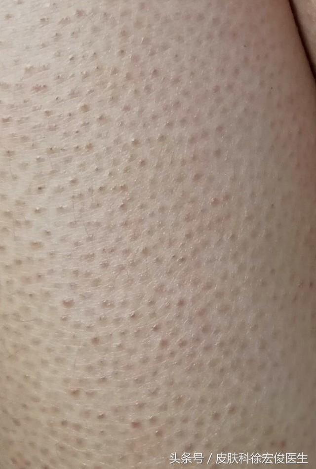 鸡皮疙瘩抹尿素霜管用吗