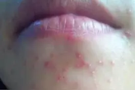 下巴反复冒痘长闭口粉刺？5点护肤注意事项，让皮肤重回健康平滑图片