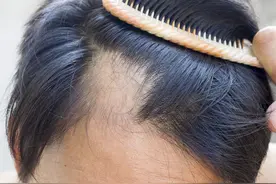 什么是“鬼剃头”？“鬼剃头”可以治好吗？图片