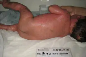 11个月宝宝全身长满鱼鳞，1个月完成蜕变，她是如何做到的？图片