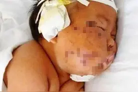 男宝因吃奶太用力，被妈妈用剪刀戳破脸，4年过去了原因才被揭晓图片