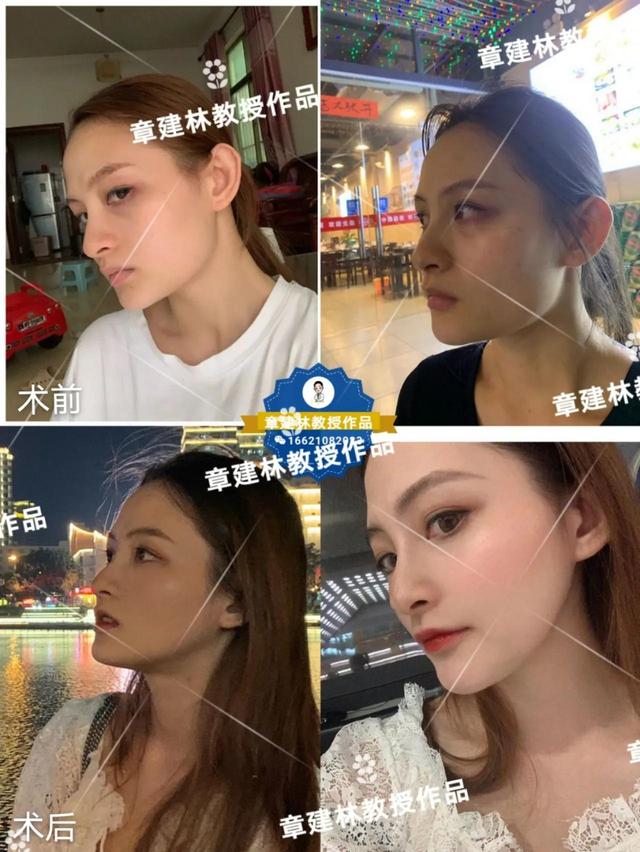 想磨骨改脸型,你最好先了解这些知识