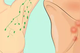 淋巴肿了，疼比不疼好！危险的淋巴结有6个特点图片