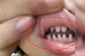孩子长了一口的“鲨鱼牙”，宝妈带娃就医，医生却说是家长的错图片