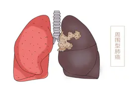 肺部有癌，胸背先知？胸背若出现两种感觉，建议早点查下肺图片