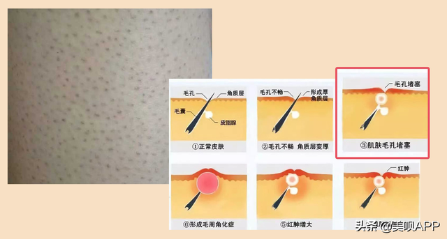 鸡皮肤多久去一次角质最好