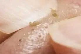 去错黑头秒变“草莓鼻”硬挤最错！3个方法成为“婴儿鼻”图片