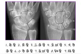 腕关节脱位类型及相关解剖(一)图片