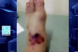 哈尔滨57岁男子被两吨重物砸碎脚，医生总结出了共性……一定要注意图片