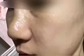 三万元做鼻综合“有点歪”（续）：监管部门介入，双方现场协调图片