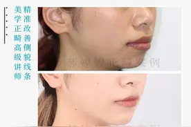 上海隐适美｜内收前牙拯救被迫外翻的嘴唇图片