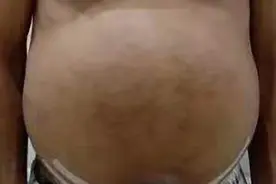 肝病出现“青蛙肚”意味着晚期，为什么肝腹水容易反复而难治？图片