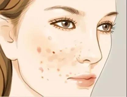 帮你去除脸上的黑色素 只需一招就能搞定(下面黑色素沉淀怎么去除)