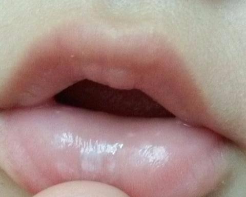 婴儿发烧不吃奶怎么办