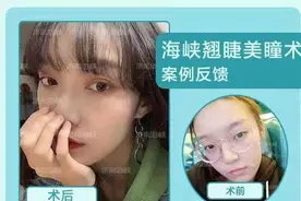 改善眼皮松弛下垂，做双眼皮or提眉？图片