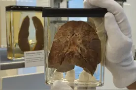 麻疹哪儿来的？基因测序揭秘图片