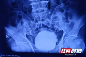 74岁老人体内取出一斤重的膀胱结石图片