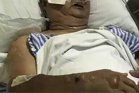 杭州有多热？78岁大伯摔了一跤躺在地上，竟然被烫伤图片