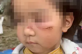 3岁女童海洋公园爬凳摔伤 脸缝4针 妈妈要求园方赔偿合理不？图片