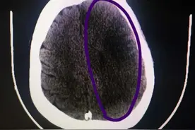 女子两个多礼拜减肥10斤，却减成了脑梗死，丧失语言功能……图片