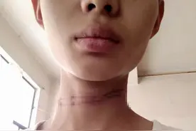 昆明外卖小哥骑车被风筝线“割喉”专家：肇事者跑掉或涉及刑事犯罪图片