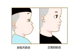 牙齿“地包天”？医生：从小预防很关键图片