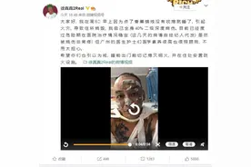 点香薰蜡烛睡觉，说唱歌手全身40%二级深度烧伤图片