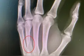 儿子写作业时玩手机，爸爸一拳挥过去，骨折了……图片