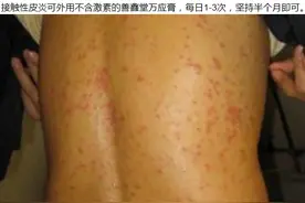 接触性皮炎怎么治？图片