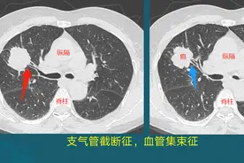 生存期较长的癌症有哪些？图片