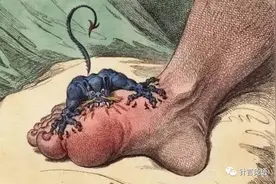 痛风与痛风针灸治疗图片
