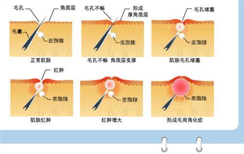 鸡皮肤毛周角化怎么消除