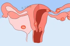 宫外孕，到底是怎么回事？有这些经历的人要注意了！丨医学图解图片