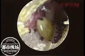 活物钻进男孩耳朵，一动就“哗啦啦”响，医生：它已经产卵了图片