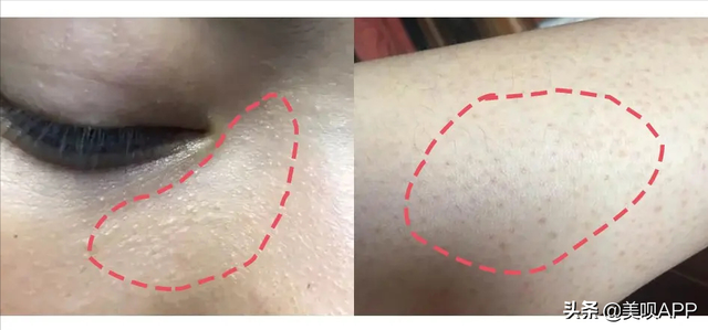 鸡皮肤多久去一次角质最好