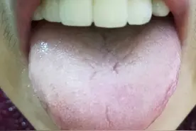 老中医讲透舌诊之胖大舌与瘦小舌舌象高清图谱解说（五）图片