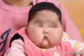 “大头娃娃”诊断医生发声：外源性激素导致患儿满月脸、水牛背、毛发重图片