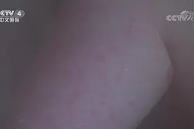 银屑病是终身疾病，只能控制不能治愈，该怎么与银屑病和平共处？视频封面