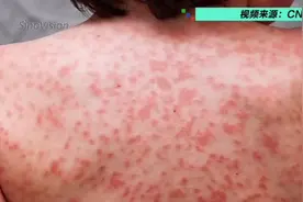 新冠儿童患者出现疑似与新冠相关的罕见综合征可能导致心脏骤停！视频封面