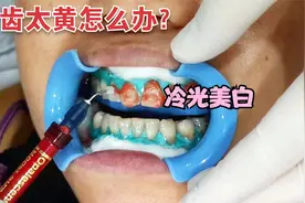 牙齿比较黄怎么办？冷光美白可以让牙齿变的更白一点，具体操作视频封面