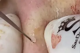 晚饭准备好，来下饭了，挤黑头解压视频封面