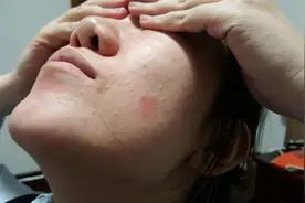 脸上反复长痘，4个因素在“作怪”！尤其第一个，早点戒掉吧视频封面