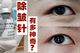硬核实测，打肉毒素去皱纹真的有用吗？眼纹消失了视频封面
