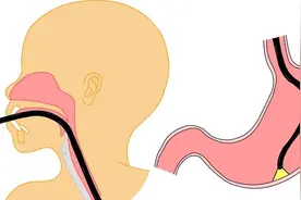 胃镜多久做一次合适？医生：没有这3种疾病，建议2到3年做一次