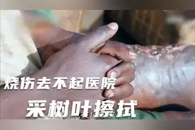 13岁孩子腿烧伤直流血，去不起医院，只得采树叶来擦拭，太可怜视频封面